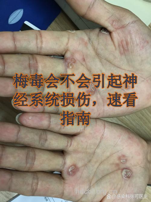 神经梅毒的危害有那些？