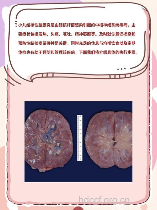 结核性脑炎的分型及病理改变