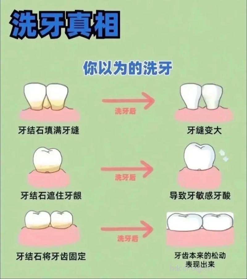 洗牙的误区有哪些呢