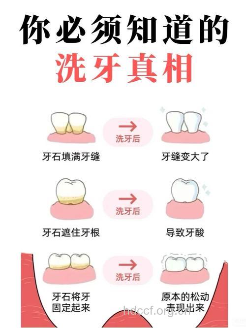 有哪些洗牙的方法呢