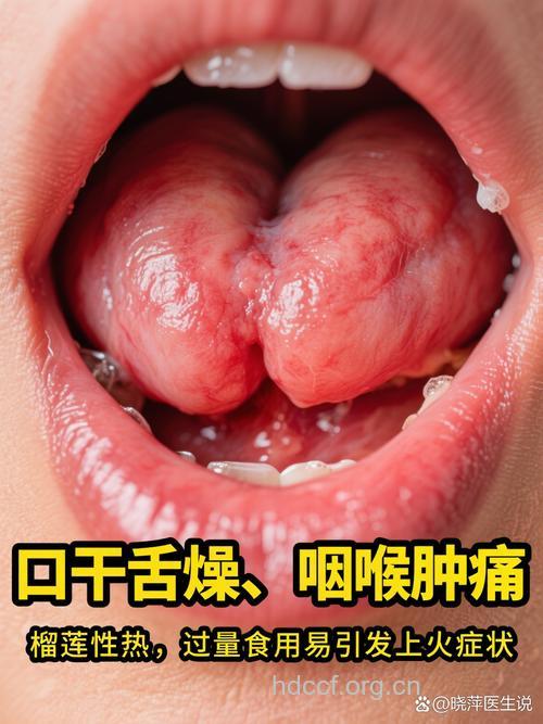 糖尿病患者吃榴莲有风险 糖友不能吃哪些水果