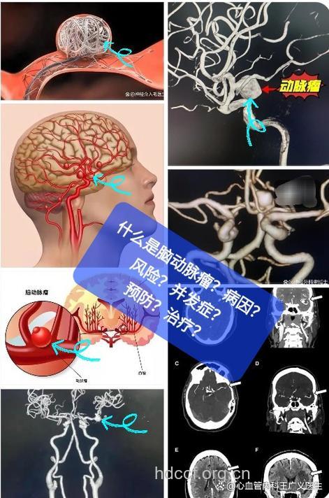 如何正确应对脑动脉瘤