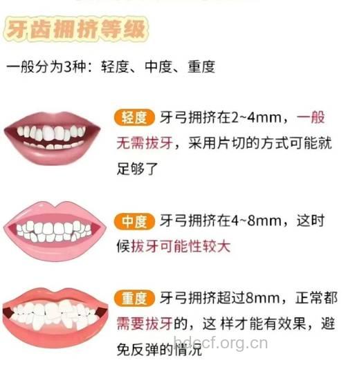 哪些因素导致牙齿排列拥挤