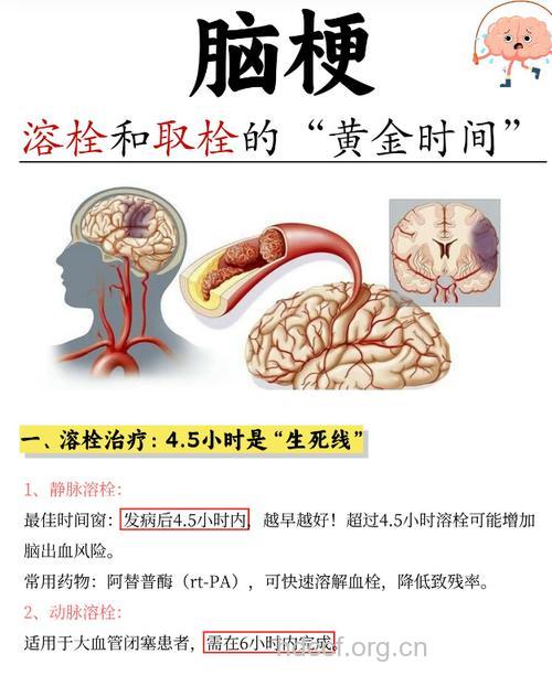 脑梗塞后3-6小时,溶栓的“黄金时间”