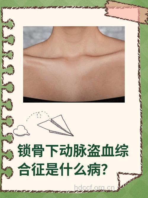 锁骨下动脉盗血综合征临床症状?
