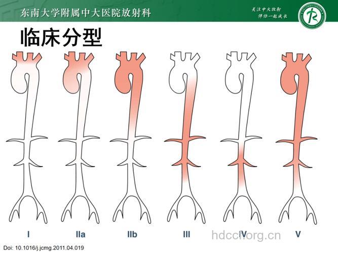 多发性大动脉炎分型及症状