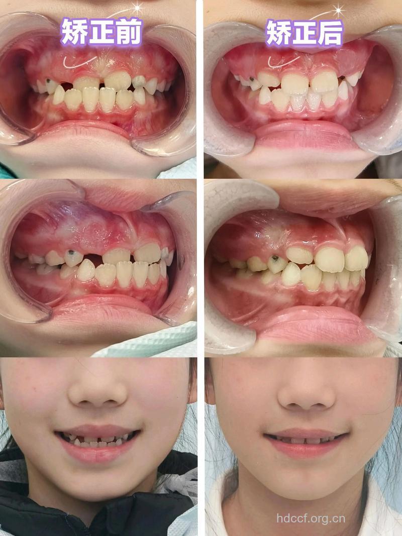 牙齿不整齐早矫正早美丽