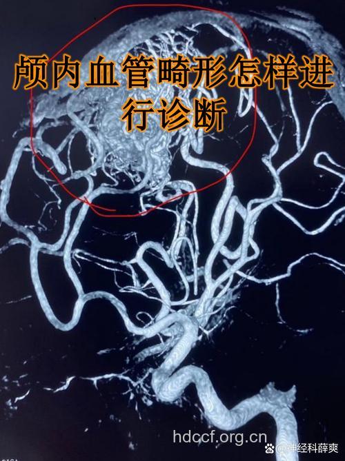 如何诊断治疗脑底异常血管网病?