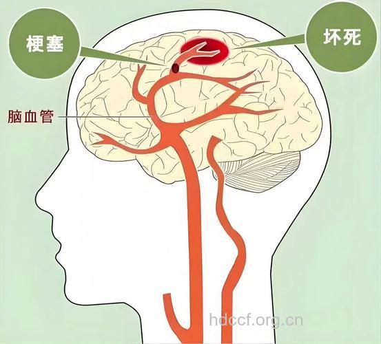 脑底异常血管网病病因及临床表现