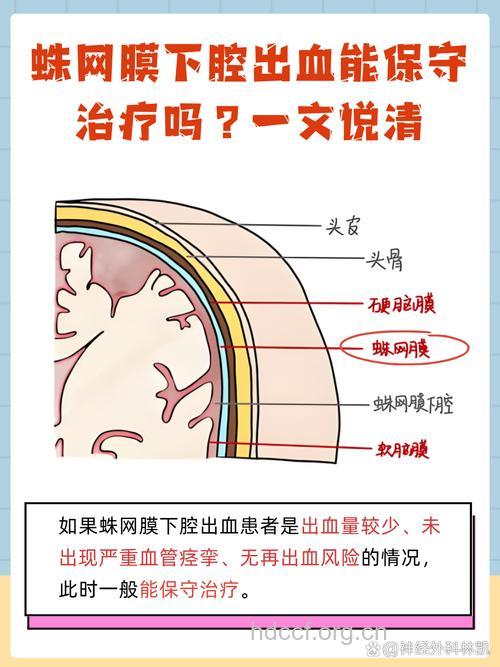 如何预防蛛网膜下腔出血