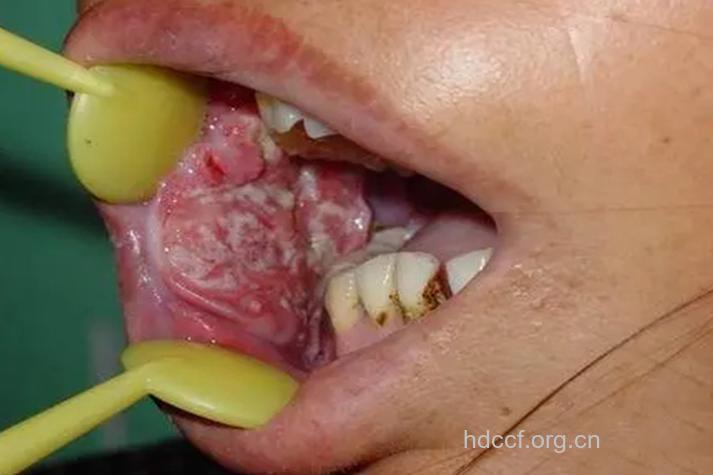 补牙不当 容易导致口腔癌