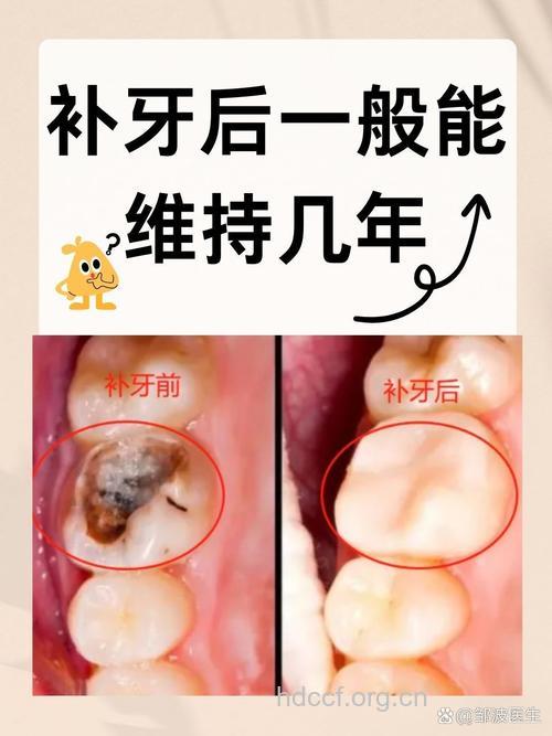 蛀牙补牙要趁早
