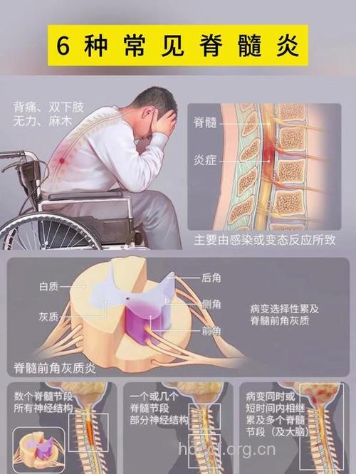 急性脊髓炎早期有哪些症状