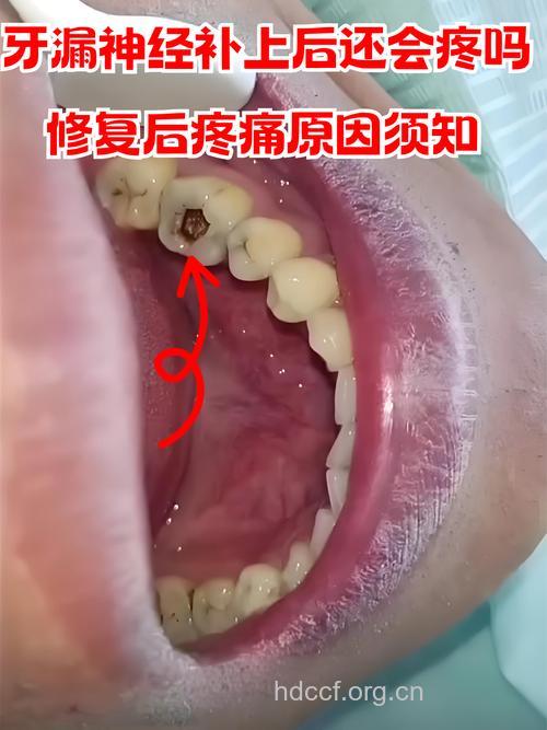 补牙杀神经会痛吗