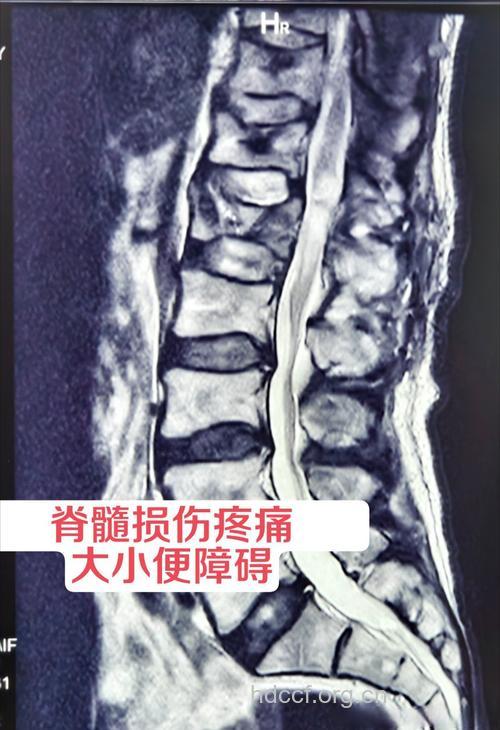 脊柱放线菌感染并发脊髓压迫症