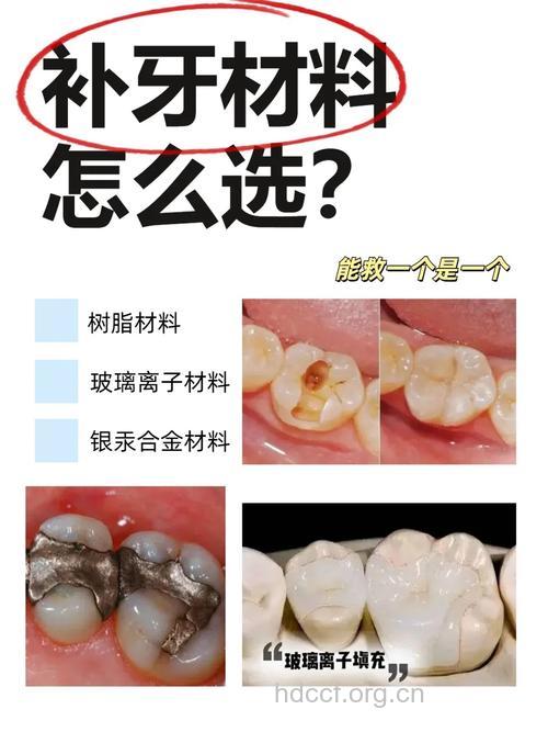 补牙材料会影响牙神经吗