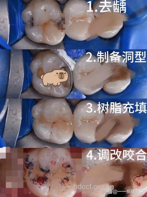 补牙的过程步骤是怎样的