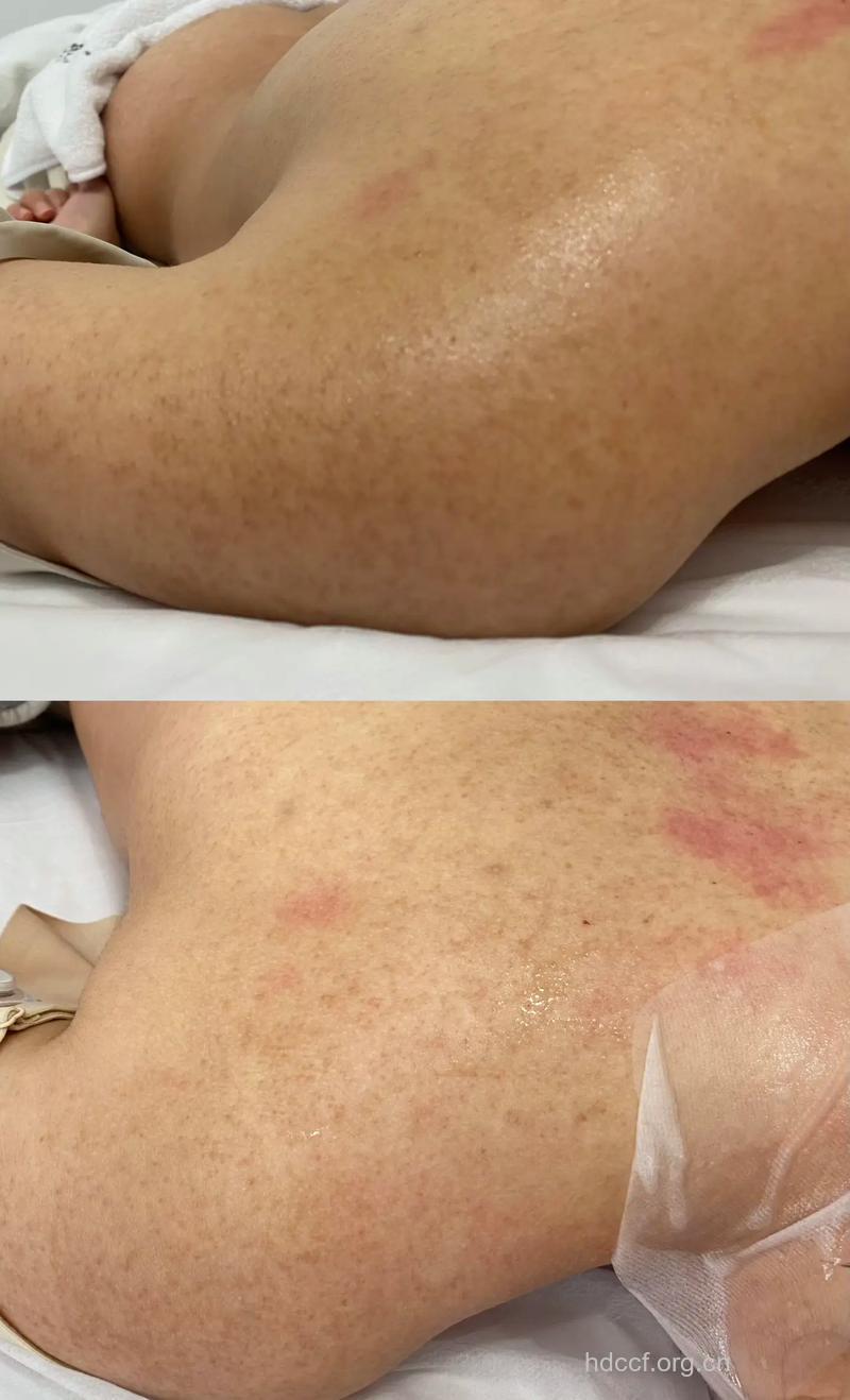 改善鸡皮肌肤 还原美白肌