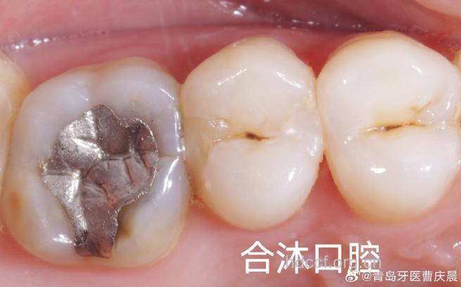 造成充填后的牙齿冷热的原因
