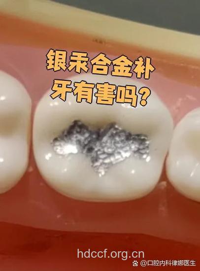 银汞合金补牙对人体有害吗？