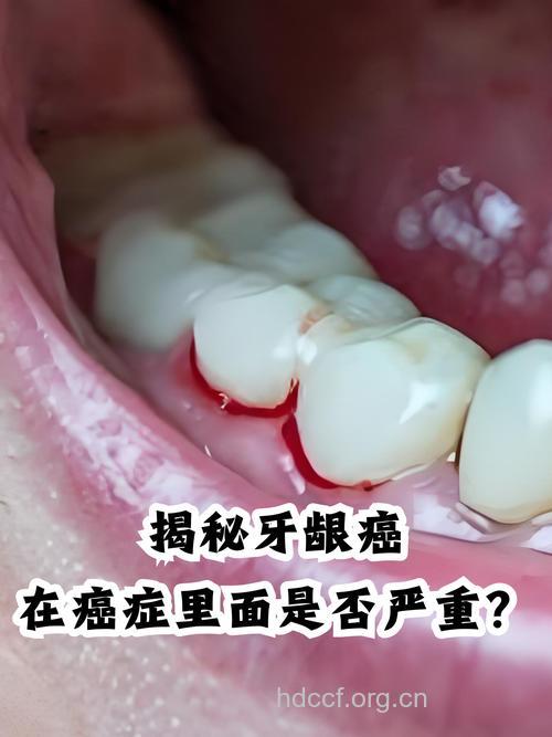 补牙不当会造成口腔癌