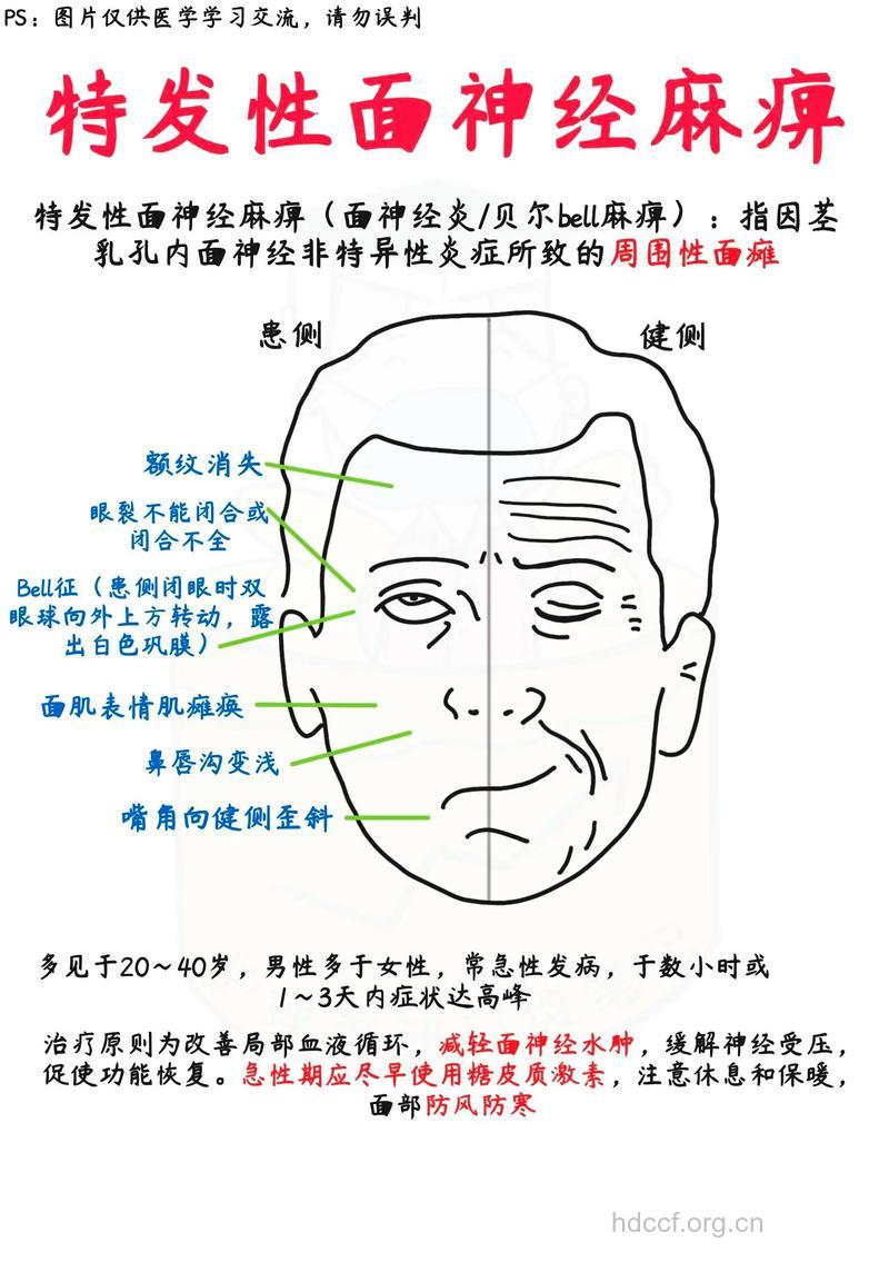 面瘫常见症状及预防方法