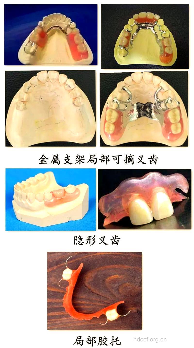 什么是可摘局部义齿