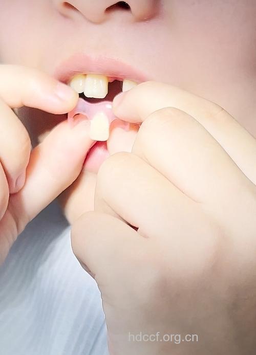 乳牙拔后用戴假牙吗