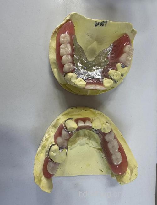 安装假牙前要准备什么