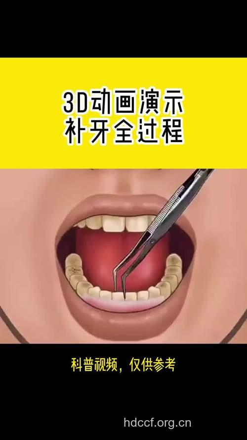 带你了解补牙的全过程