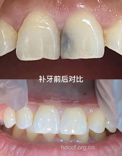 补牙后需要做牙套保护补过的牙。
