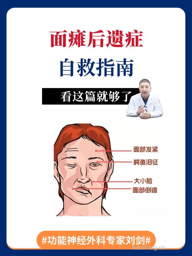 关于面瘫有什么后遗症