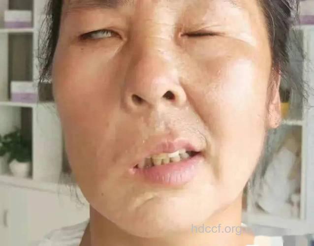 面瘫初期有什么症状