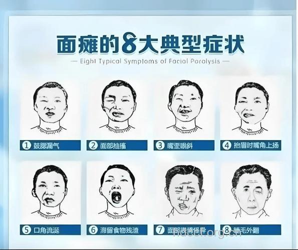 哪些人群容易面瘫