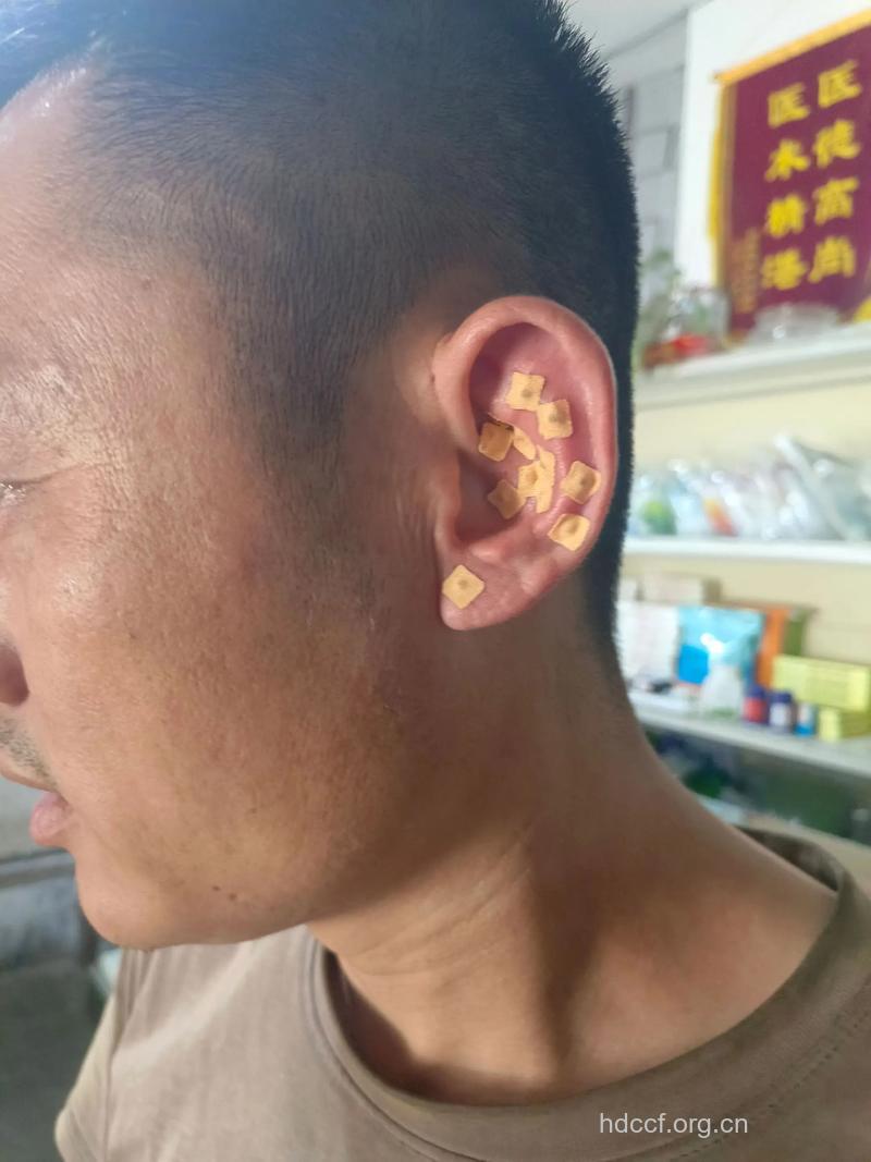 打耳洞损健康 严重可诱发面瘫