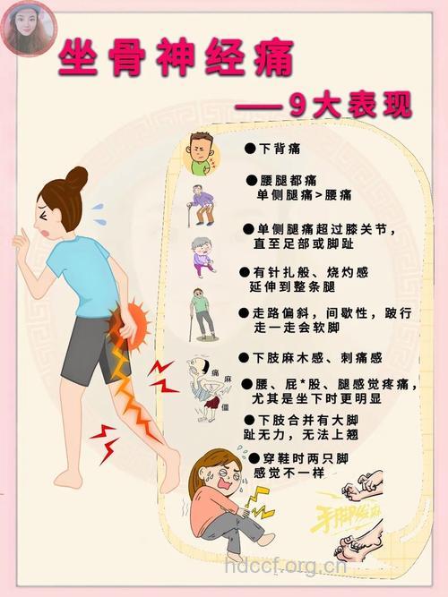 坐骨神经痛症状