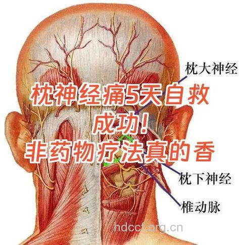 枕大神经痛的治疗