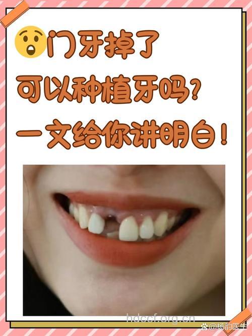 门牙掉了可以种植牙吗