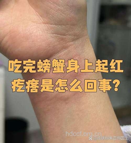 坐月子吃螃蟹会导致宝宝湿疹?