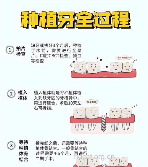 教你如何正确选择种植牙