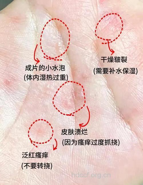 湿疹手上长水泡？三招轻松解决