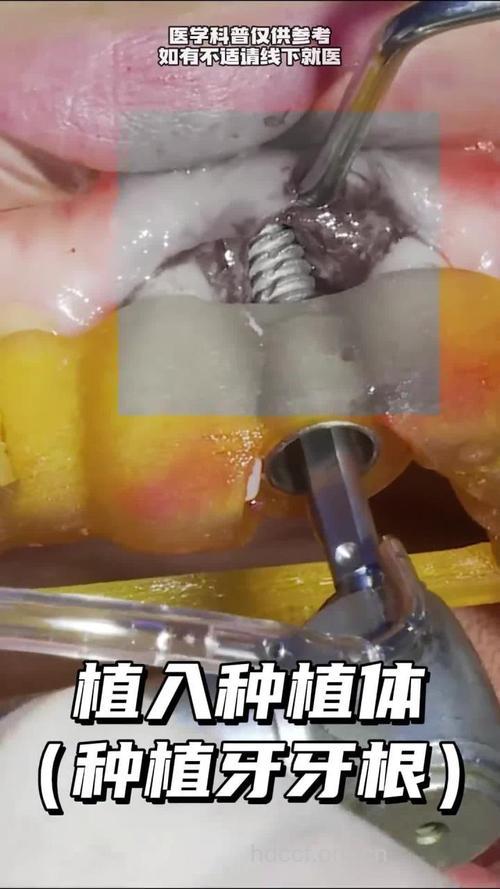 种植牙根是什么形态设计的