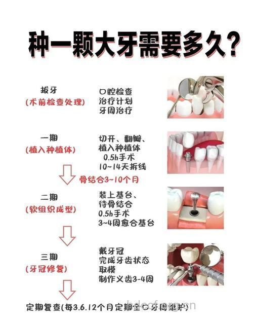 如何正确选择种植牙