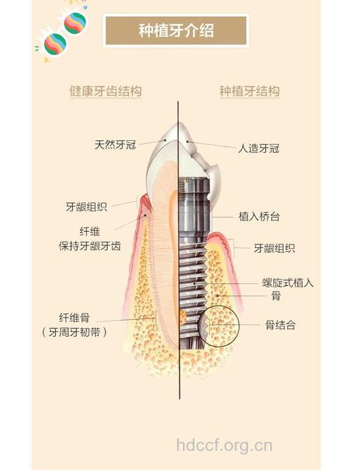 怎么正确选择种植牙齿方法