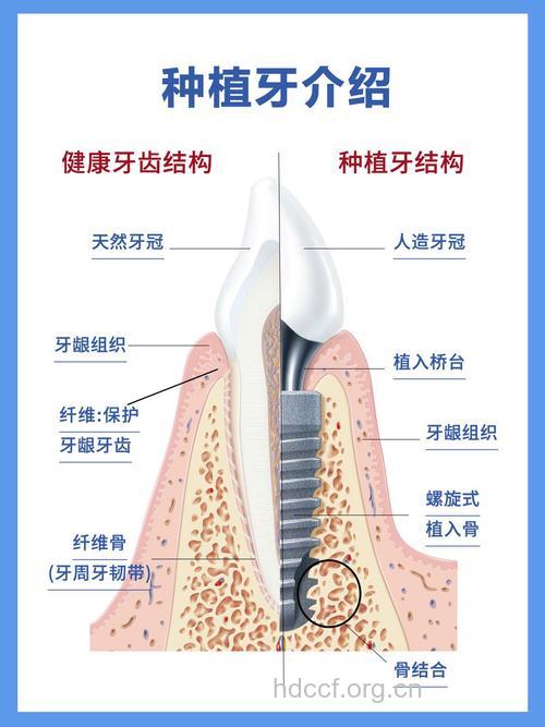 关于种植牙齿有哪些基本常识