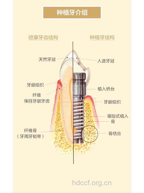 关于种植牙有哪些原理