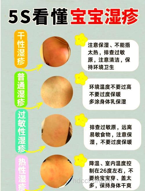 冬季要谨防儿童干性湿疹