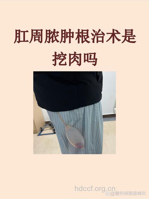 治疗肛周脓肿需“斩草除根”
