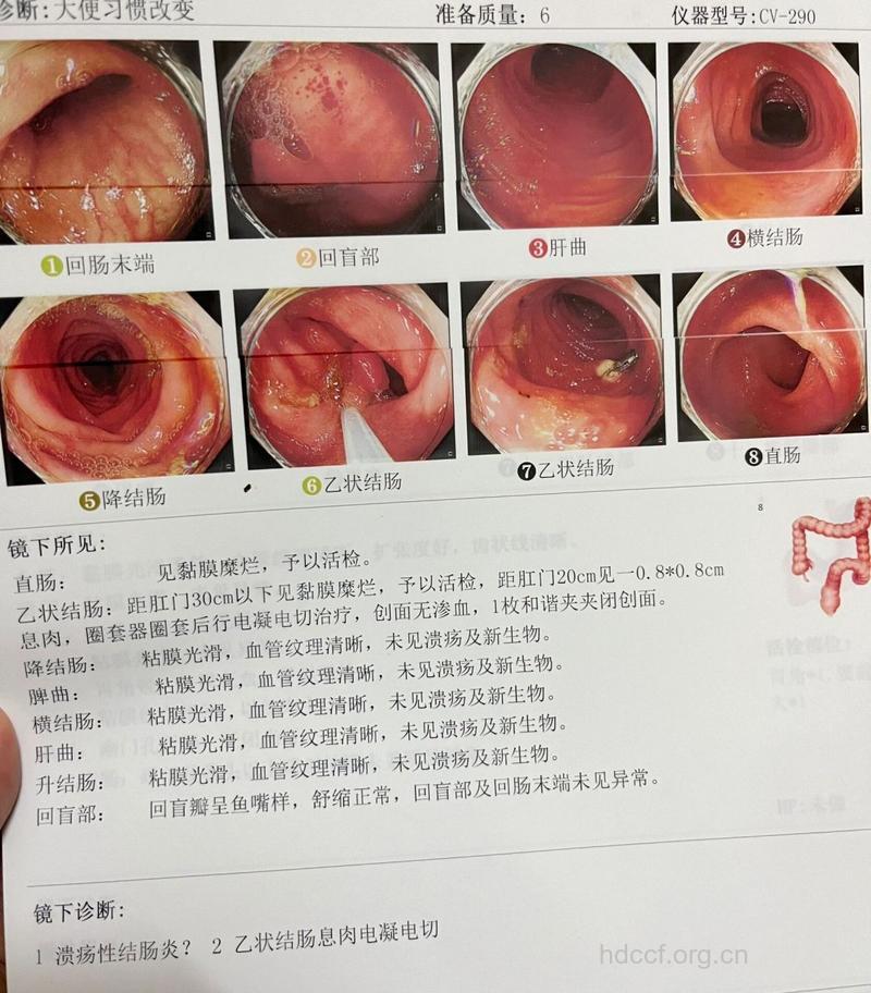 用内镜检查溃疡性结肠炎