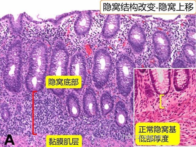 溃疡性结肠炎的病理变化